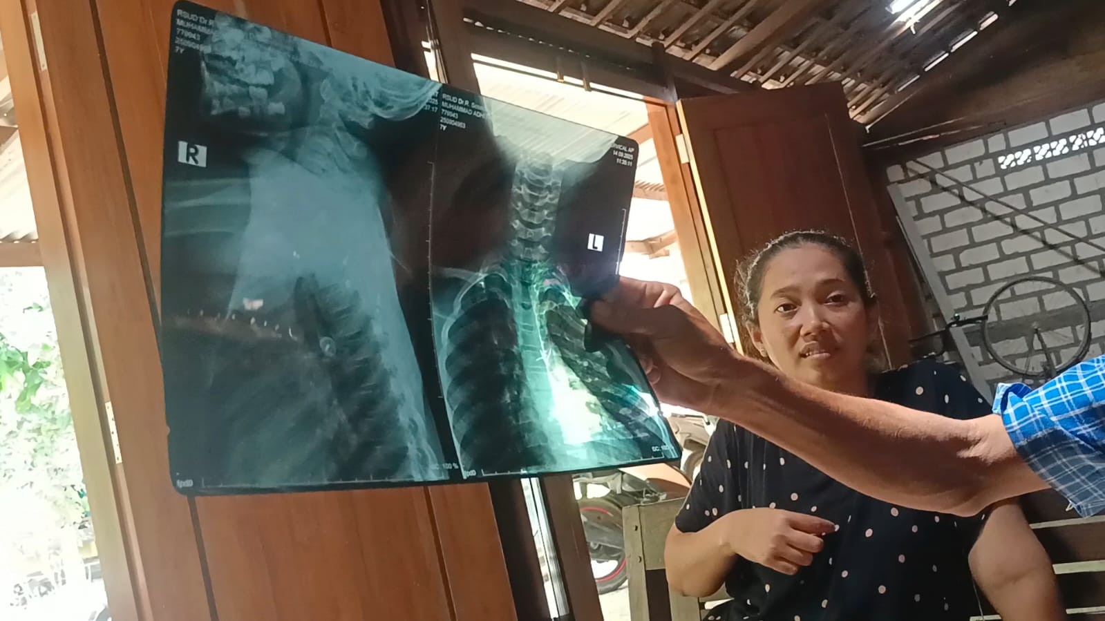 Bocah telan paku pines.